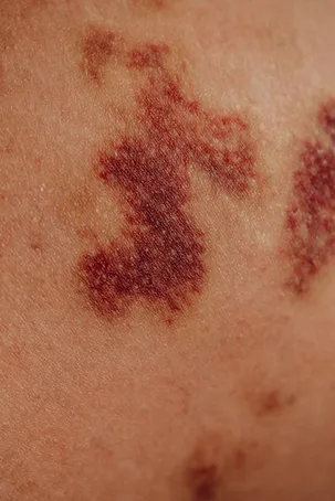 3. Reduce la inflamación y enrojecimiento