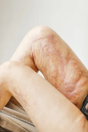 Cura de quemaduras y heridas
