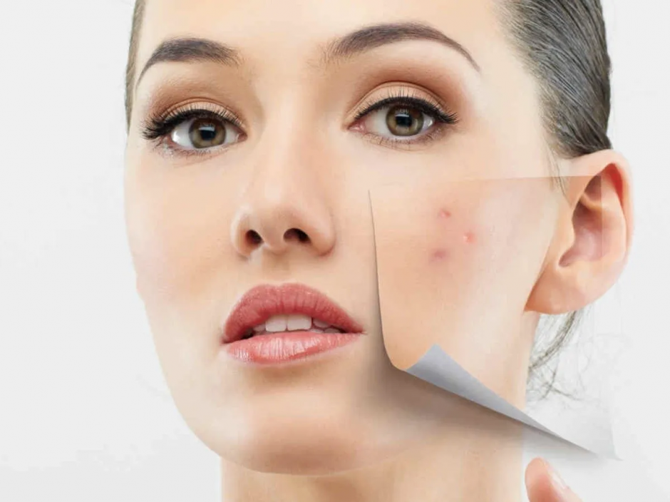 limpia-tu-sangre-y-dile-adios-al-acne-descubre-como-hacerlo