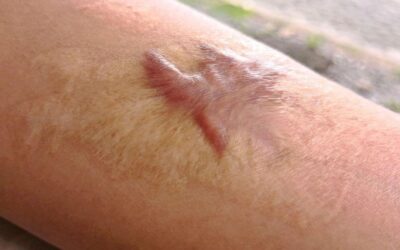 ¿Quitar un queloide por tu cuenta? Descubre las consecuencias