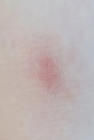 Síntomas de la dermatitis