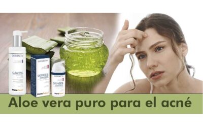 Aloe vera para combatir los granos de forma efectiva