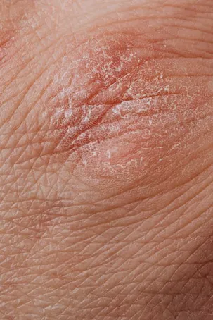 Tipos de dermatitis